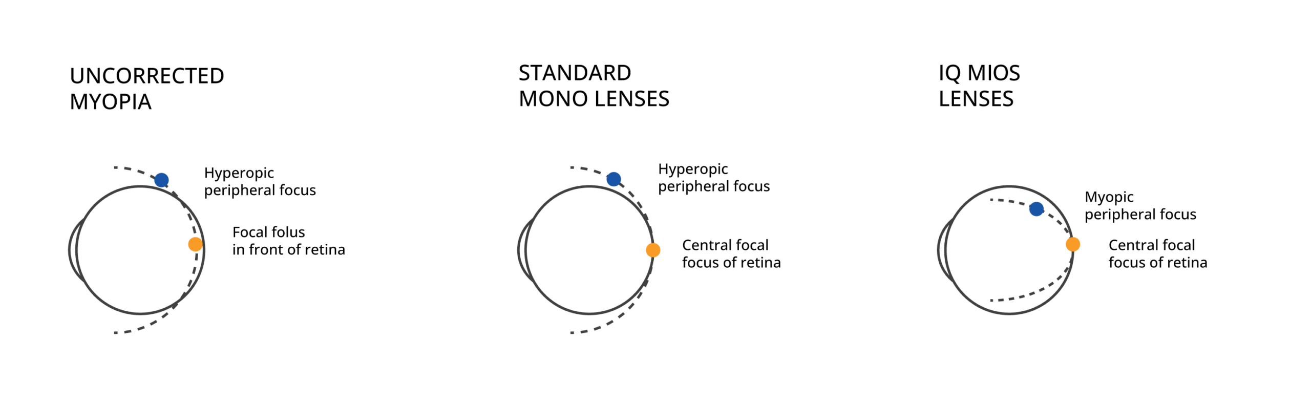 myopia1-en-uk